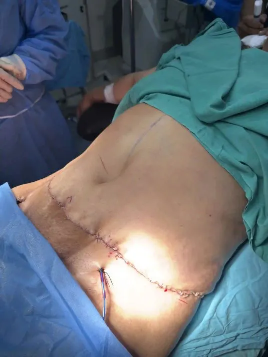 After Tummy Tuck